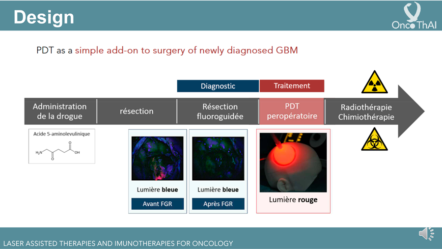 Thérapie photodynamique PDT dans le Glioblastomes GBM, une tumeur au cerveau