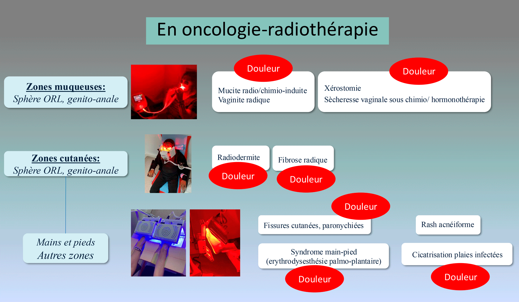 Usages de la Photobiomodulation PBM dans soins du cancer